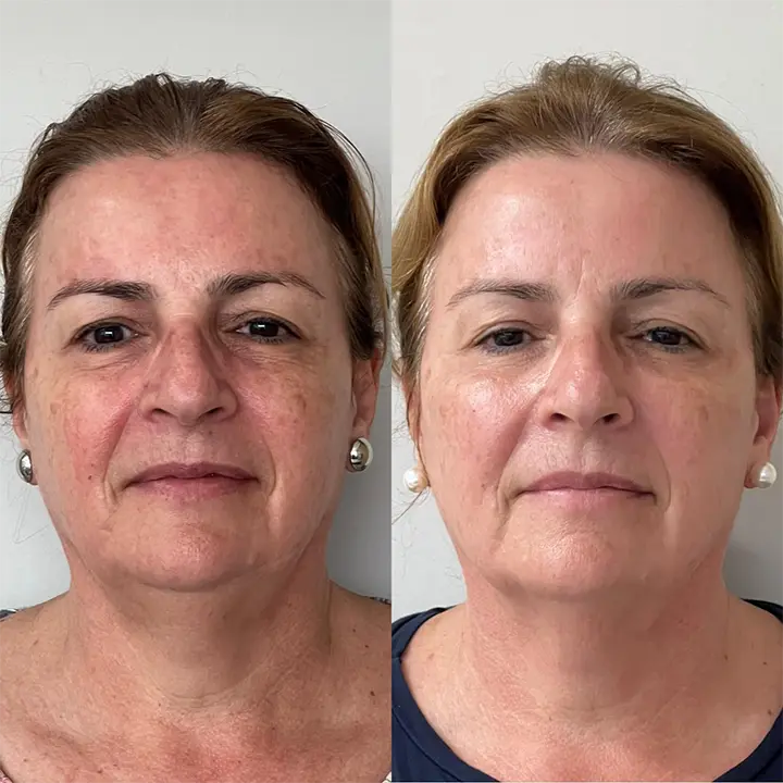 AnyConv.com__Skinbooster4